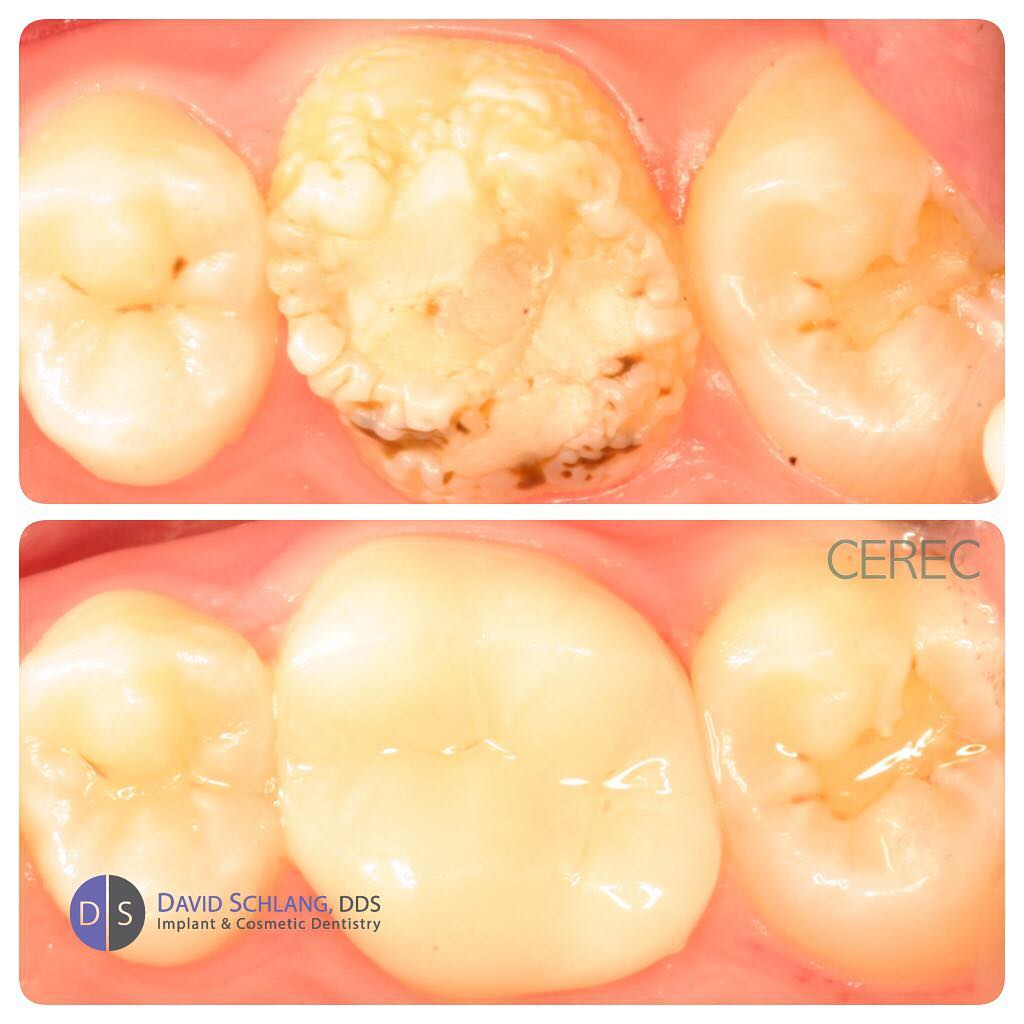 Instagram post by Dr. David Schlang: Nice result on a 'same day single visit crown' #crown #cerec #dentist