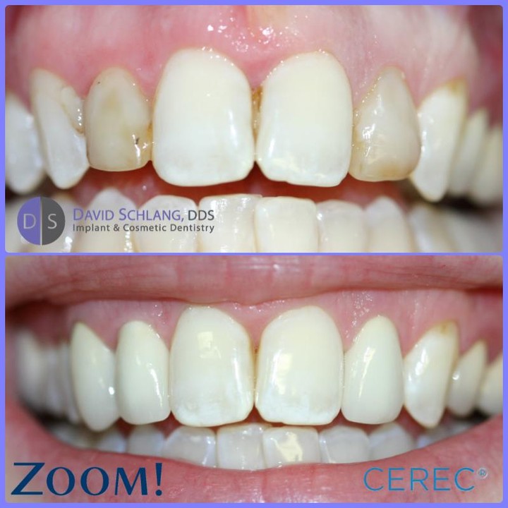 Instagram post by Dr. David Schlang: Nice result, kept it conservative #Zoom #CEREC #Bonding