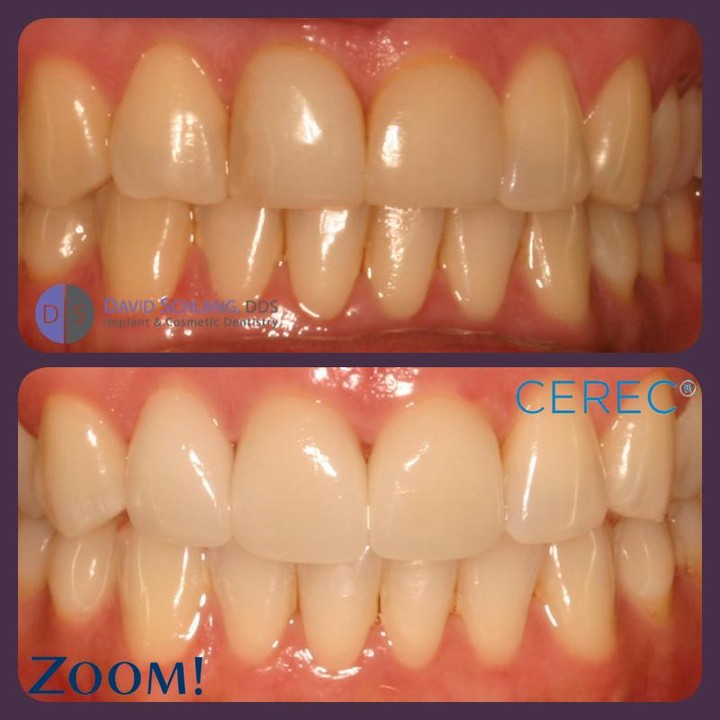Instagram post by Dr. David Schlang: Beautiful! #CEREC #Zoom Whitening