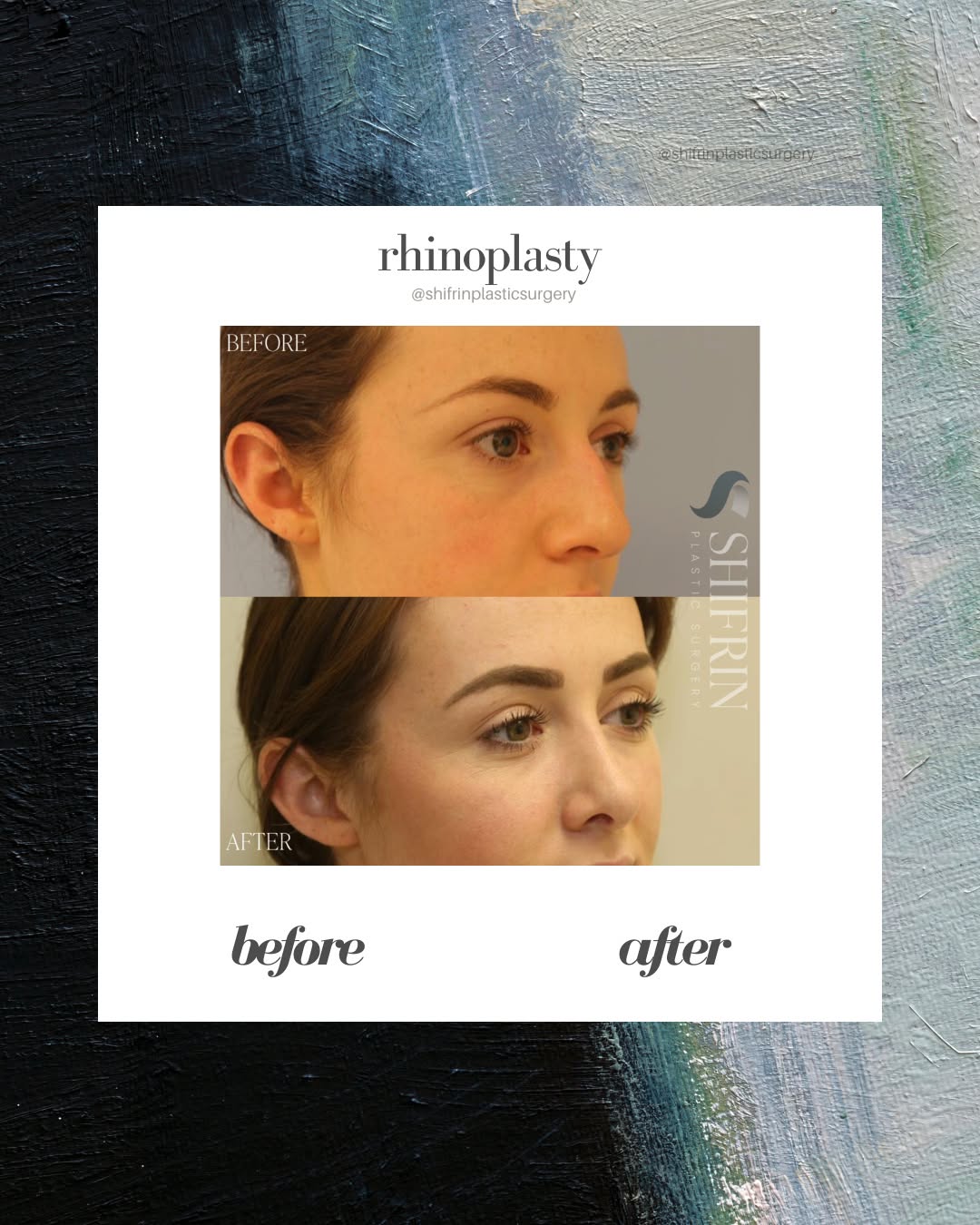 Instagram post by Dr. David Shifrin: Subtle changes make all the difference!✨ This 24 year old female wanted to refine her nasal appearance. She did not like the bump on her …