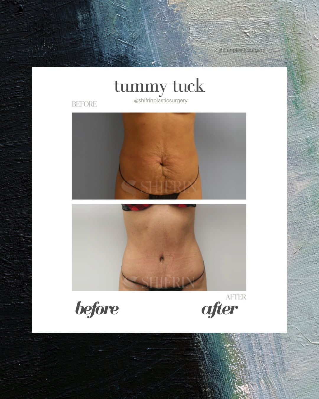 Instagram post by Dr. David Shifrin: A transformation focused on shape, contour, and confidence. ✨ This 35-year-old patient was concerned with the appearance of stretch marks…