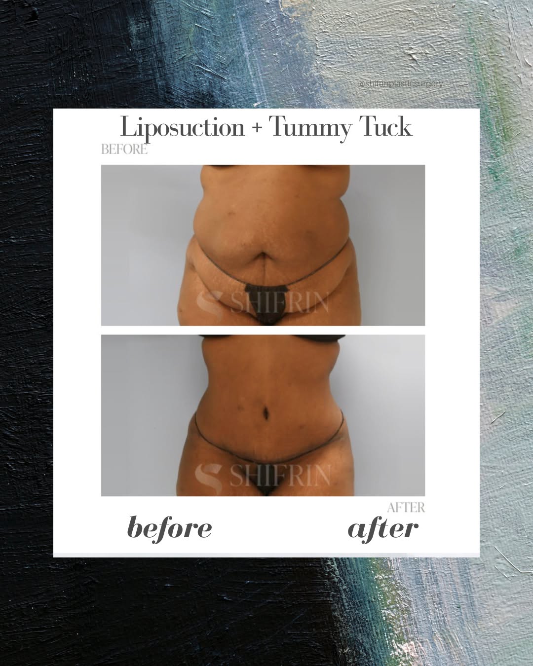 Instagram post by Dr. David Shifrin: Creating shape is about looking at the midsection as a whole. ✨ This 44-year-old patient wanted to address excess abdominal skin, stretch…