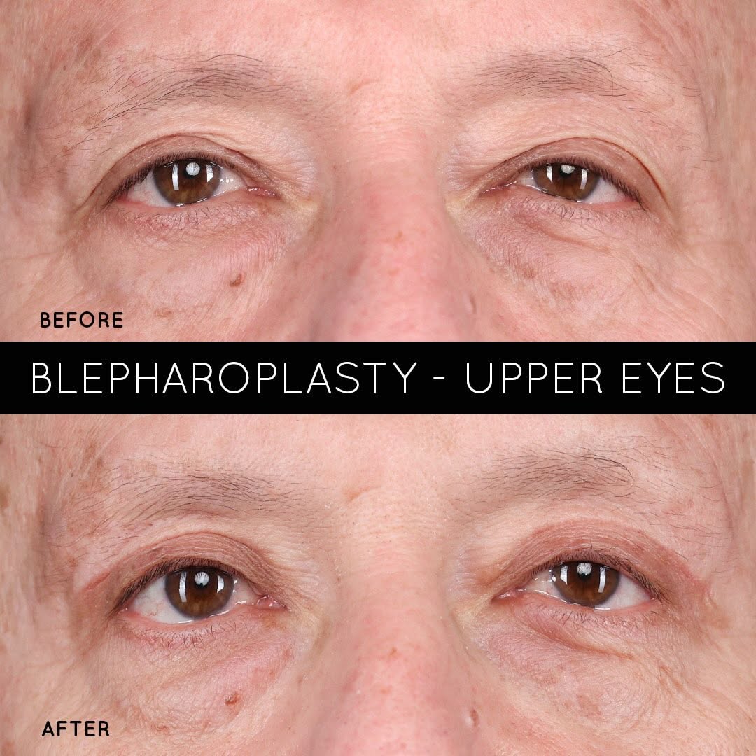 Instagram post by Dr. David Shokrian: ✨ A More Refreshed, Youthful Look Upper blepharoplasty can help remove excess skin and fat from the upper eyelids, creating a more open, ref…