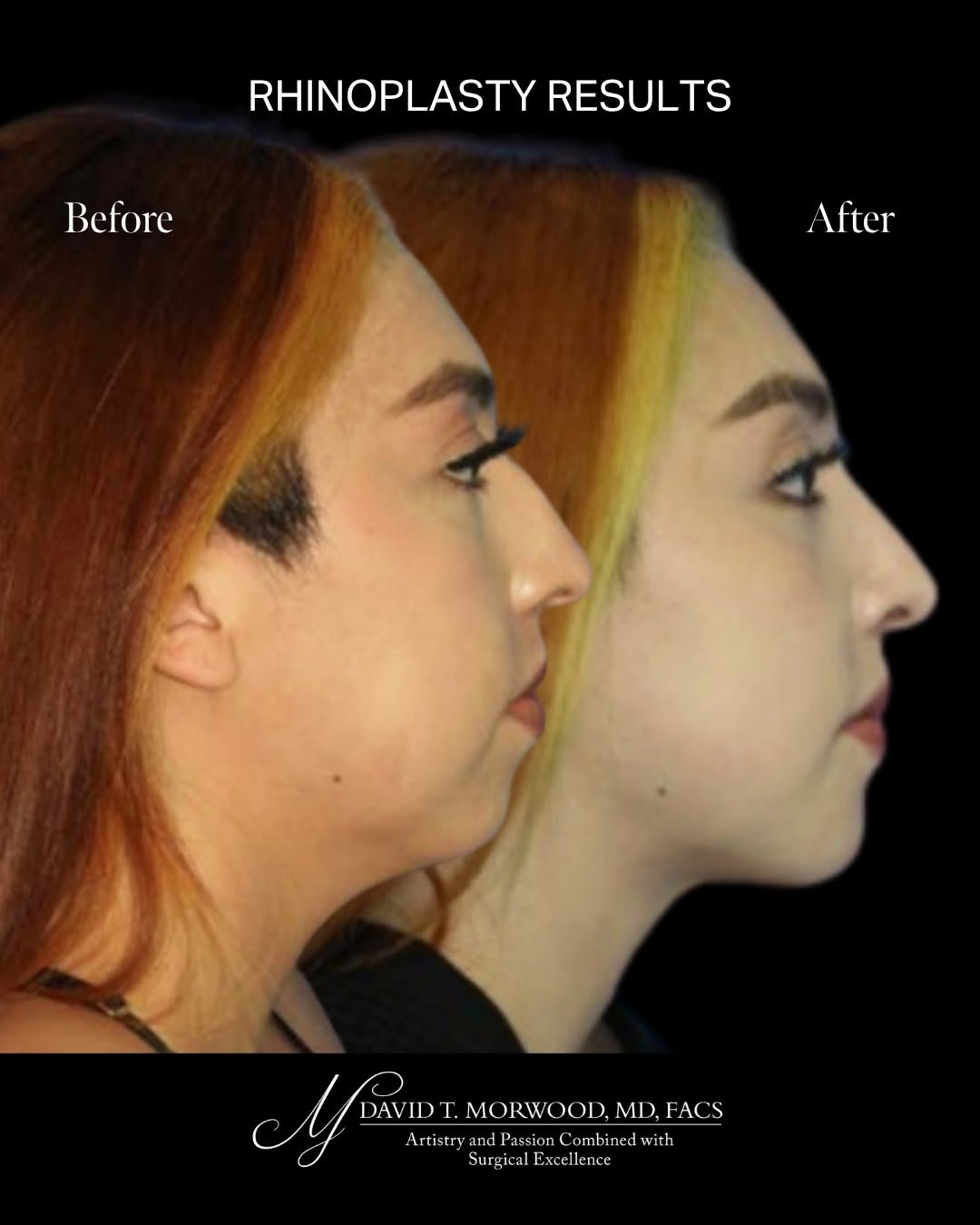Instagram post by Dr. David T. Morwood: A well-performed rhinoplasty isn't about changing who you are; it's about bringing your features into balance. This patient came to us looki…