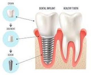 Instagram post by Dr. David Taler, DDS, FAGD, DABOI/ID: Missing a tooth? This might be your answer! Why ? Natural looking appearance, Long-Term solution, can be used to replace multiple teeth. Com…