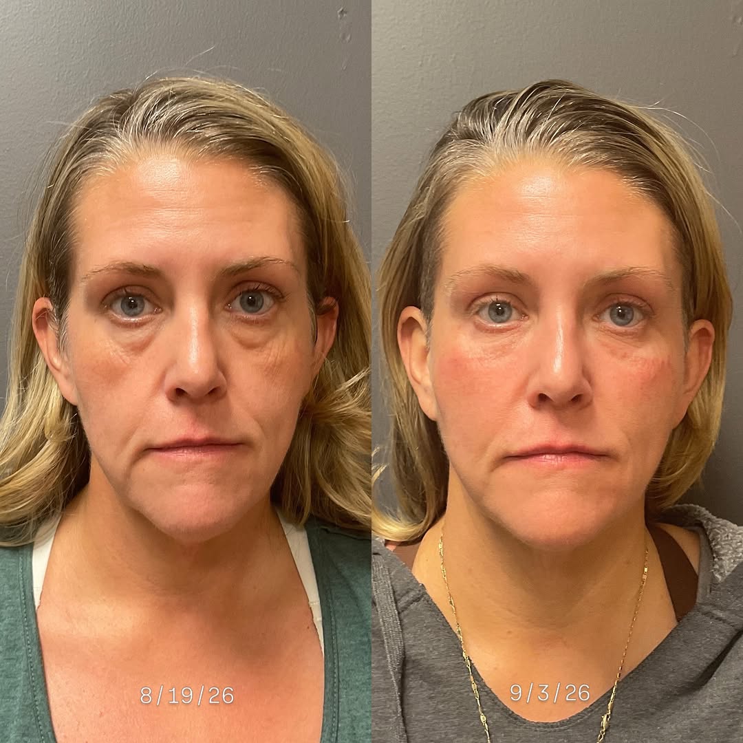 Instagram post by Dr. David V. Pratt: Session #2: Address under eyes. My first recommendation was a #lowerlidblepharoplasty, but it became apparent that surgery wasn’t on this br…