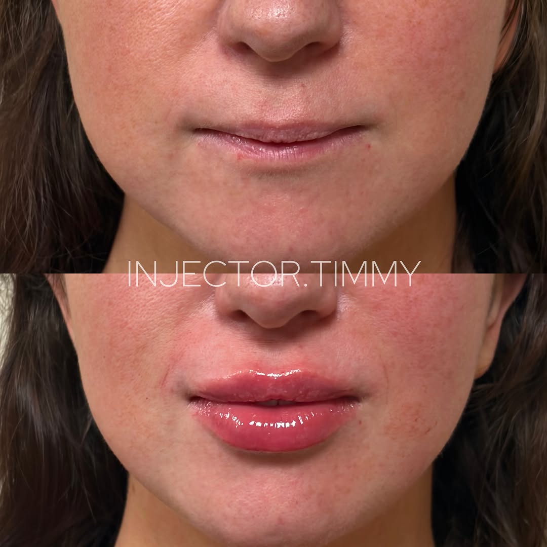 Instagram post by Dr. David V. Pratt: [The Kissable Pout] - My signature natural result lip enhancement that suits your own facial anatomy. Lip filler isn’t just about volume; it…