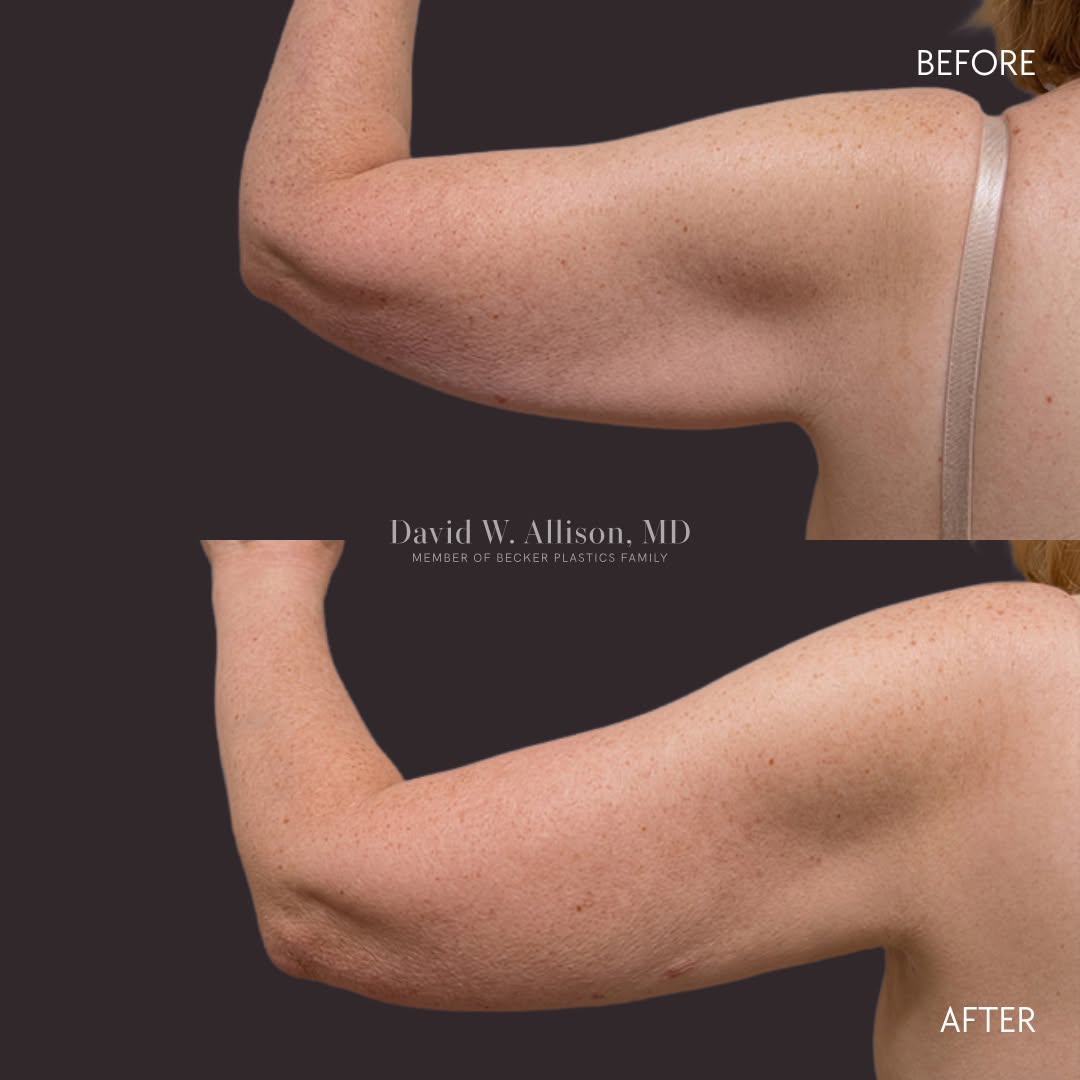 Instagram post by Dr. David W. Allison: At 6 months post-op, this patient's upper arm liposuction results reveal a smoother, more sculpted contour by targeting stubborn fat that wa…