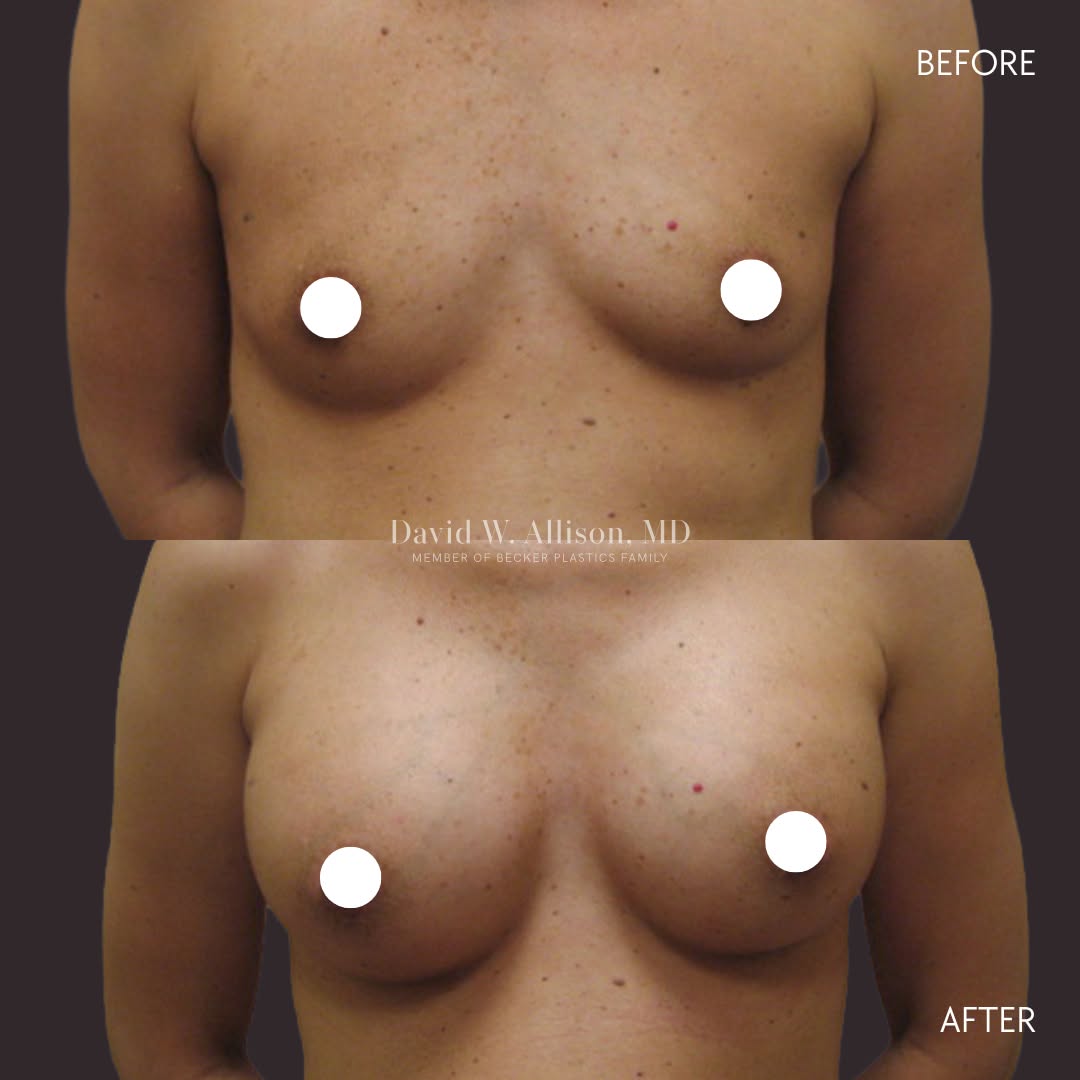 Instagram post by Dr. David W. Allison: Subtle, balanced, and beautifully proportioned! This 28-year-old patient underwent breast augmentation with 325 cc smooth, round silicone ge…