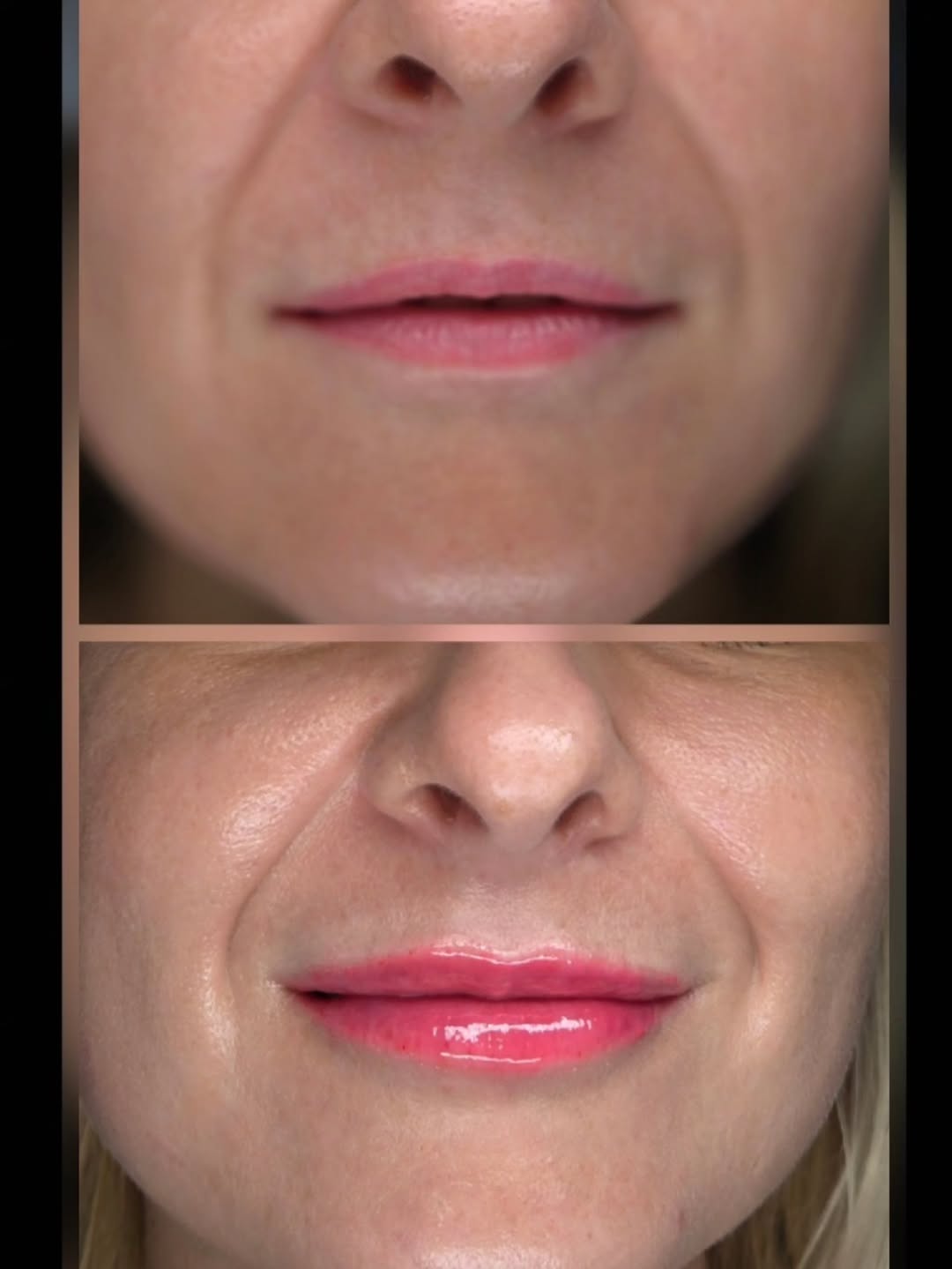 Instagram post by Dr. David W. Kim: Always in season for lip filler! This gorgeous patient wanted to treat herself and undergo a lip refresh! She was one of the amazing models …