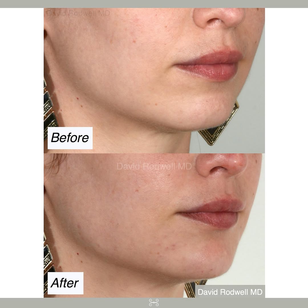 Instagram post by Dr. David W. Rodwell III: Chin and jawline enhancement just got even better! . One of our favorite fillers #RestylaneDefyne was recently approved by the FDA for impro…