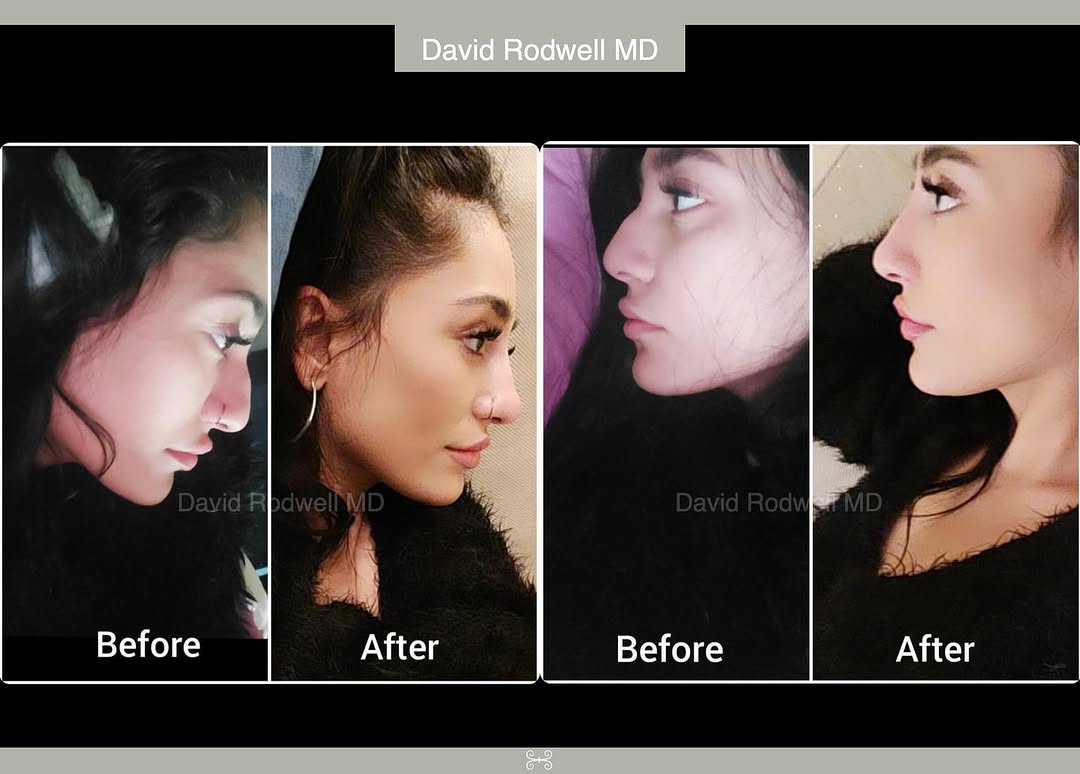 Instagram post by Dr. David W. Rodwell III: Thanks to this patient who was thrilled to share her before & after selfies after a non-surgical rhinoplasty. . Using filler can be a great …