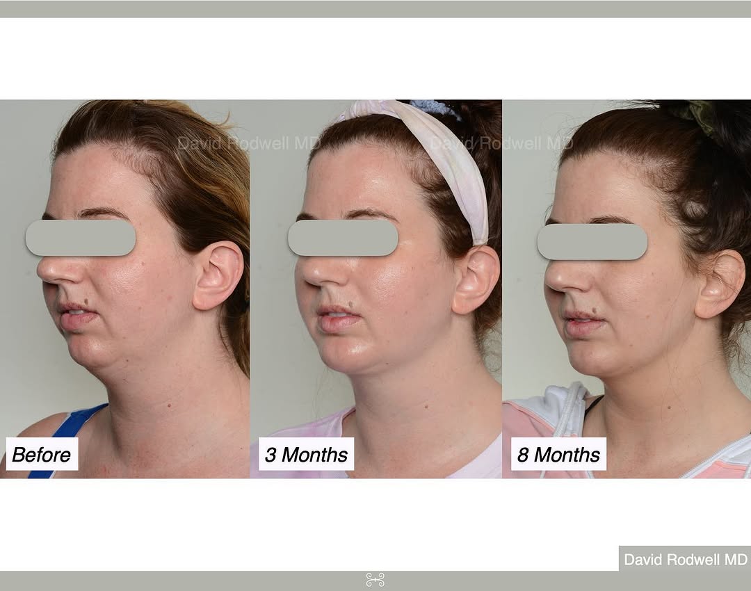 Instagram post by Dr. David W. Rodwell III: AMAZING results for this patient who had #Facetite with liposuction and a chin implant! 😁 . The first picture is a fantastic example of how…