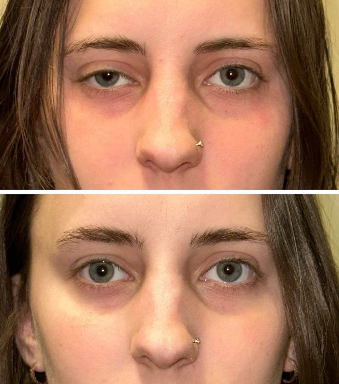 Instagram post by Dr. David Z. Gay: Unilateral ptosis repairs in young adults is one of my favorite things to fix. In this group I usually perform an internal surgery meaning t…