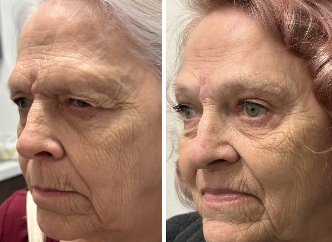 Instagram post by Dr. David Z. Gay: I perform several styles of brow lifts. What I don’t do is over lift brows. Nobody wants to look surprised all the time! For this patient I …