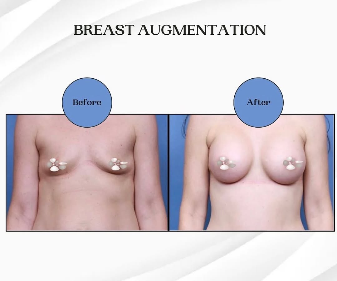 Instagram post by Dr. Dax Guenther: ✨ Your Breast Augmentation Should Be As Personal As You Are. ✨ When it comes to breast augmentation, there’s no one-size-fits-all approach. …