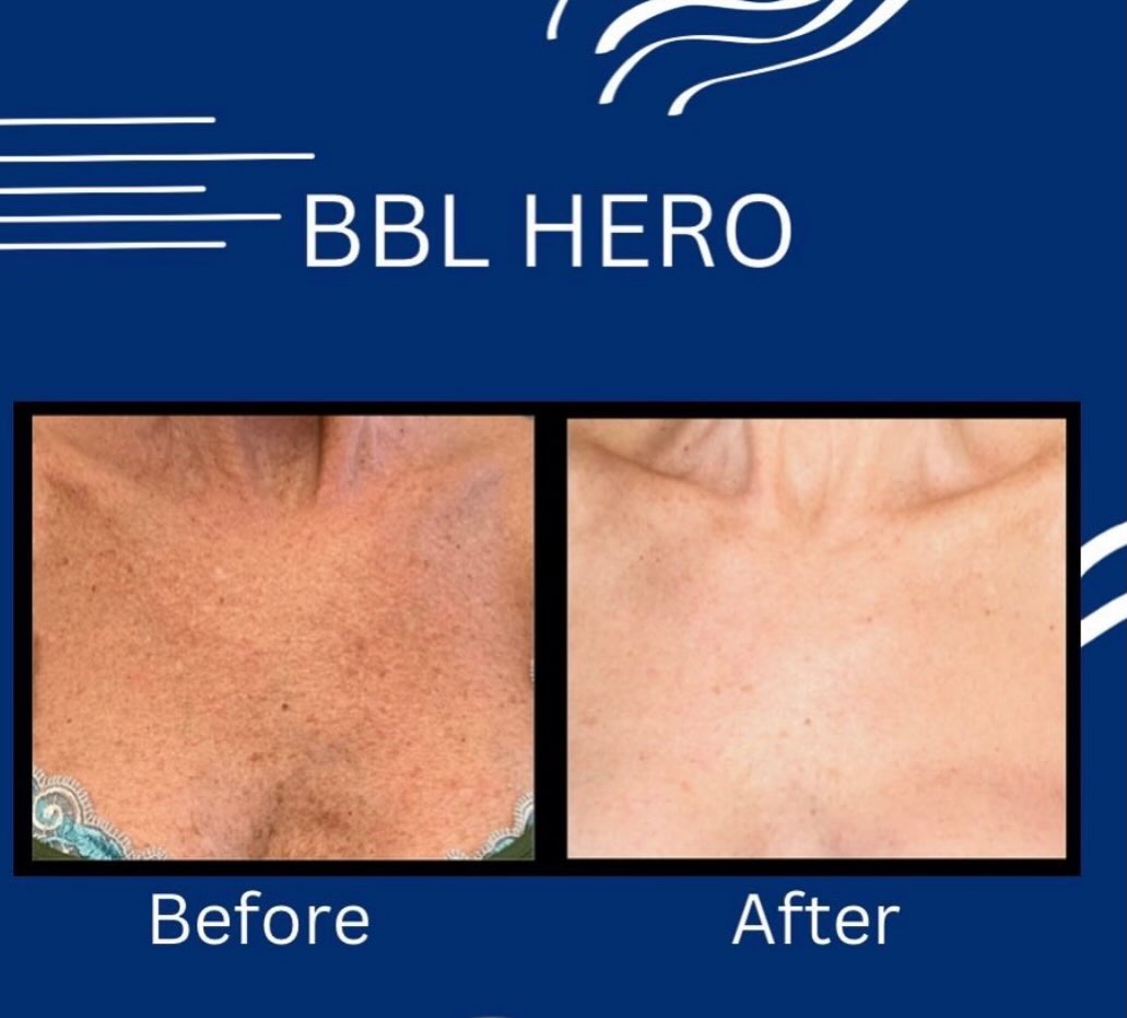 Instagram post by Dr. Dax Guenther: WHY BBL CAN GO BEYOND TRADITIONAL IPL ✨ You may have heard BBL and IPL used interchangeably but there are some important differences. 👇🏼 B…