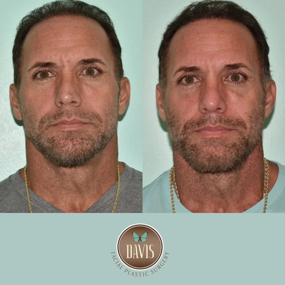 Instagram post by Dr. Dean G. Davis: Improved symmetry can make a subtle change feel significant. As swelling continues to decrease over the coming months, his results will cont…
