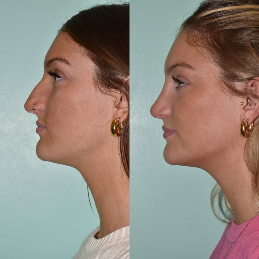 Instagram post by Dr. Dean G. Davis: A beautiful look at what 8 months of healing brings. 𝐑𝐡𝐢𝐧𝐨𝐩𝐥𝐚𝐬𝐭𝐲: 𝟖 𝐌𝐨𝐧𝐭𝐡𝐬 𝐏𝐨𝐬𝐭-𝐎𝐩 #davisfacialplasticsurgery #noseb…