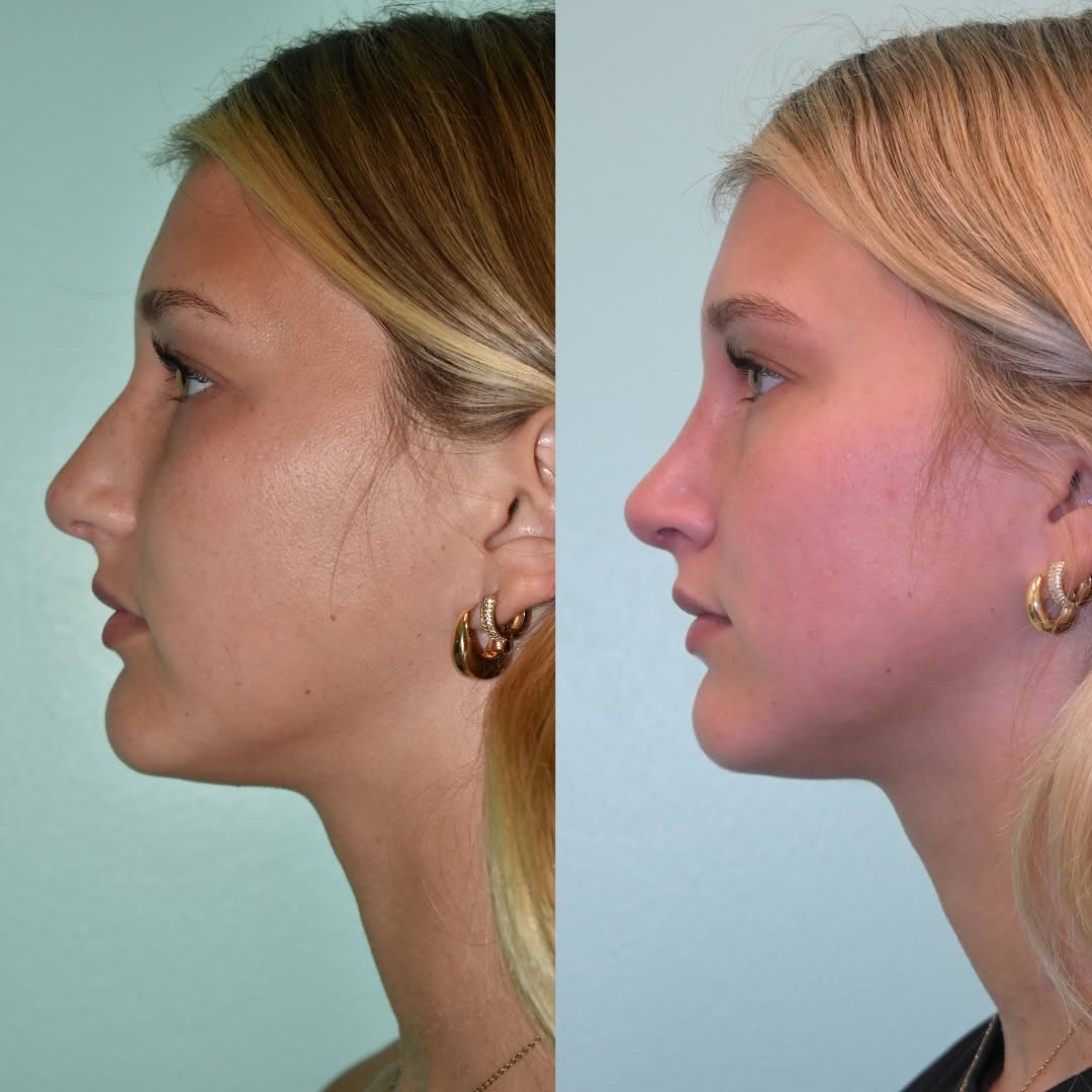 Instagram post by Dr. Dean G. Davis: Three months out, and her new profile feels like it was always meant to be hers. 𝐑𝐡𝐢𝐧𝐨𝐩𝐥𝐚𝐬𝐭𝐲: 𝟑 𝐌𝐨𝐧𝐭𝐡𝐬 𝐏𝐨𝐬𝐭-𝐎𝐩 #nose…
