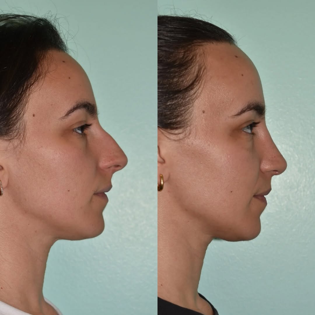 Instagram post by Dr. Dean G. Davis: A little change, a beautiful difference. Three months post-op, and her rhinoplasty results are already shining through. We look forward to s…