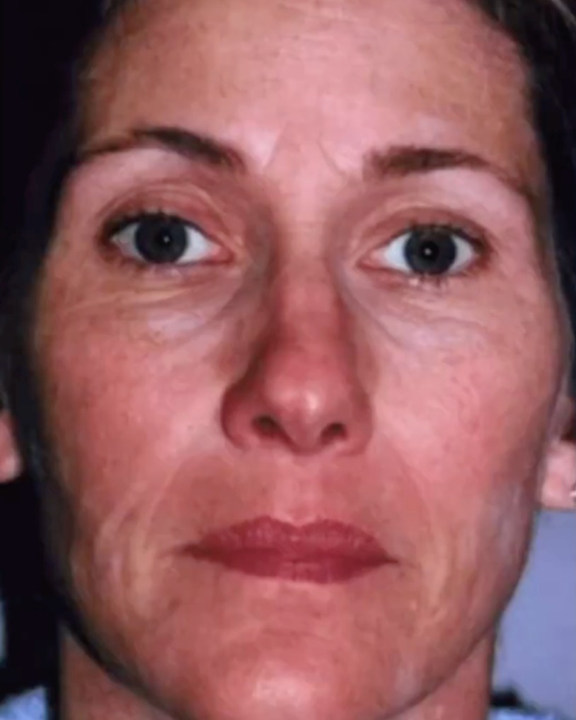 Instagram post by Dr. Dean P. Kane: Time for a fall peel to erase all that summer sun damage. TCA Peels offer incredible results. Swipe for afters. Call to book. #drdeankane #t…