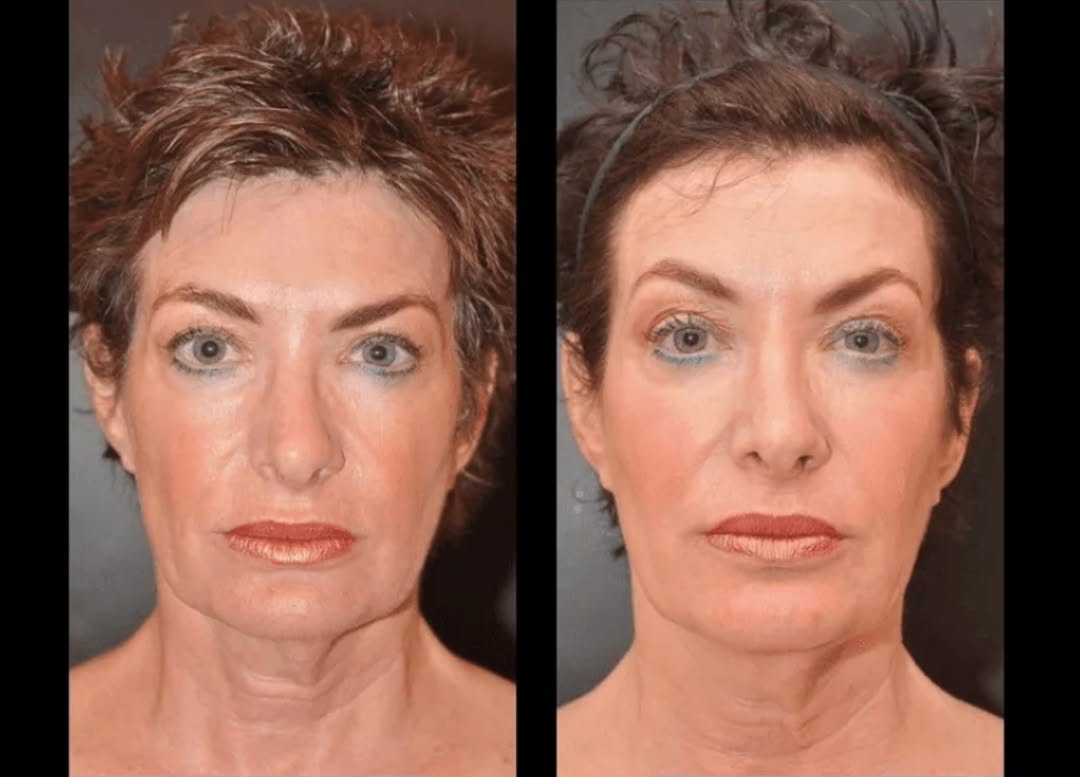 Instagram post by Dr. Dean P. Kane: Sculptra can stop and reverse the signs of aging in a natural, gradual, and lasting way. Age backwards with Sculptra. Swipe for amaxing B&As…