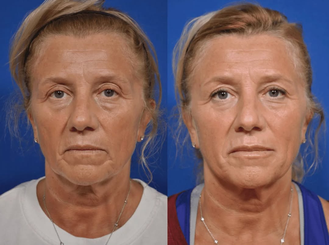 Instagram post by Dr. Dean P. Kane: The right use of fillers can do amazing things! #drdeankane #columbiamd #plasticsurgery #beforeandafter