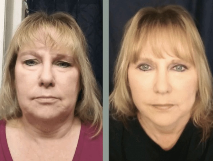 Instagram post by Dr. Dean P. Kane: No surgery required. Dr. Kane uses tailored combinations of non-surgical procedures for facelift-like results. #drdeankane #plasticsurgery #…