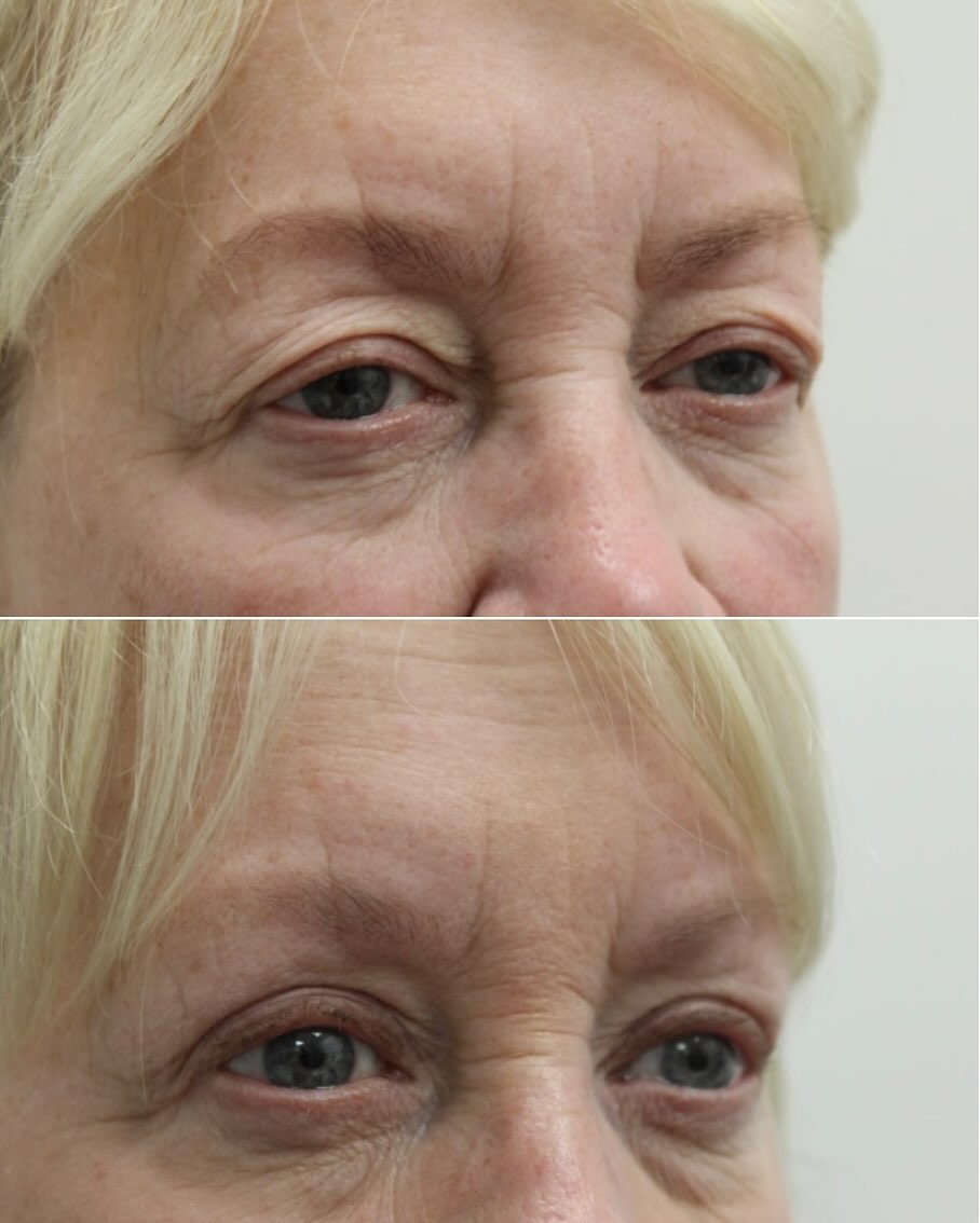 Instagram post by Dr. Deborah Ekstrom: Upper Lid Blepharoplasty (eyelid lift) can help open the eyes and improve your appearance by taking the excess skin off your upper lids. It …