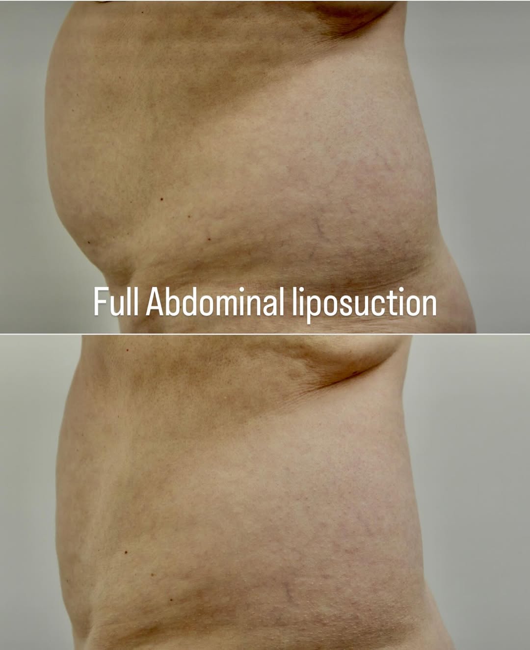 Instagram post by Dr. Deborah Ekstrom: 60 year old shown s/p Full Abdominal Liposuction . Patient is only 8 weeks post op. She already feels great and feels she is much more motiv…