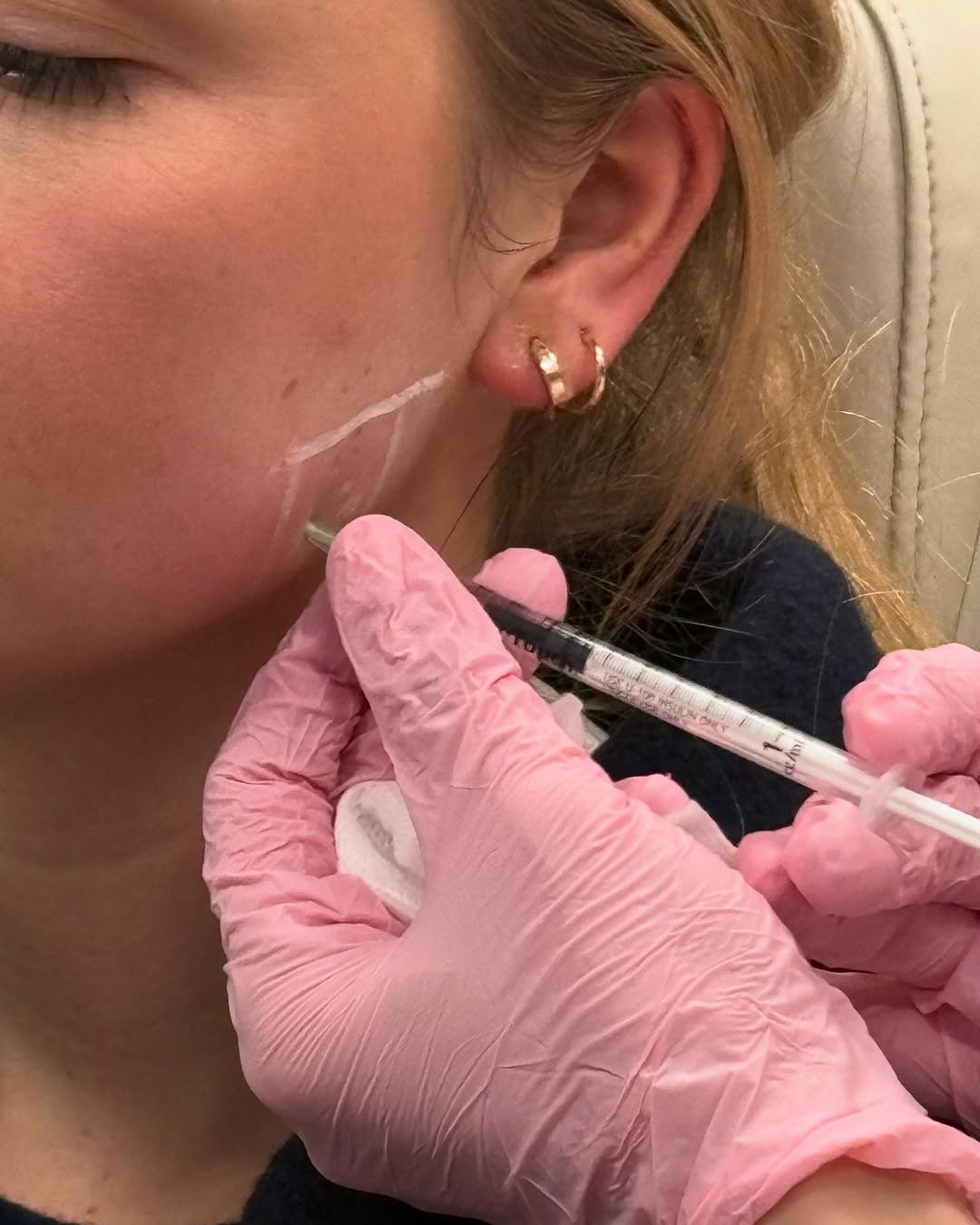 Instagram post by Dr. Deborah Ekstrom: Masseter Botox - do you suffer from TMJ? Do you grind or clench your teeth at night? Dysport or Botox into the masseter muscle may be able t…