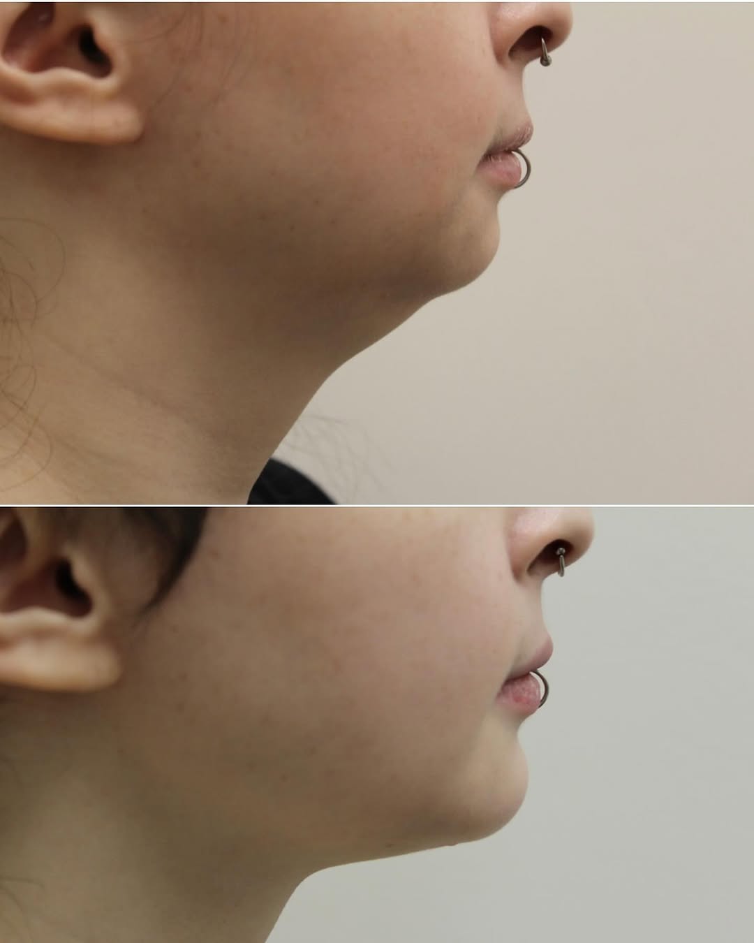 Instagram post by Dr. Deborah Ekstrom: Liposuction of the submental area with a chin implant! This 28 year old did not like her profile and had liposuction along with a chin impla…