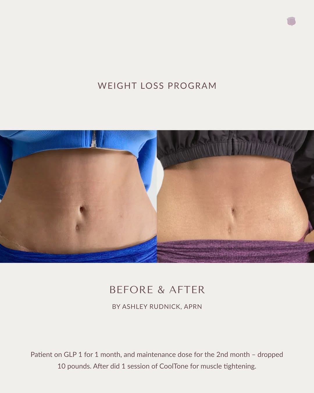 Instagram post by Dr. Deborah M. Longwill, DO: Real progress, personalized to the patient. ✨ After one month on a GLP-1 medication followed by a maintenance dose during month two, this pa…