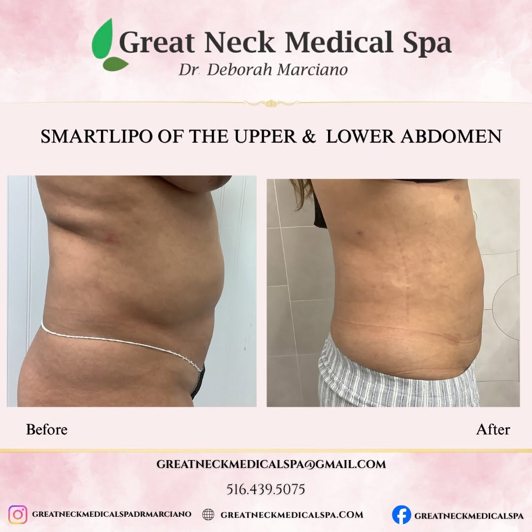 Instagram post by Dr. Deborah Marciano, DO: ✨ Sculpted. Defined. Confident. ✨ Liposuction of the upper and lower abdomen helps remove stubborn fat pockets and enhance your natural cont…