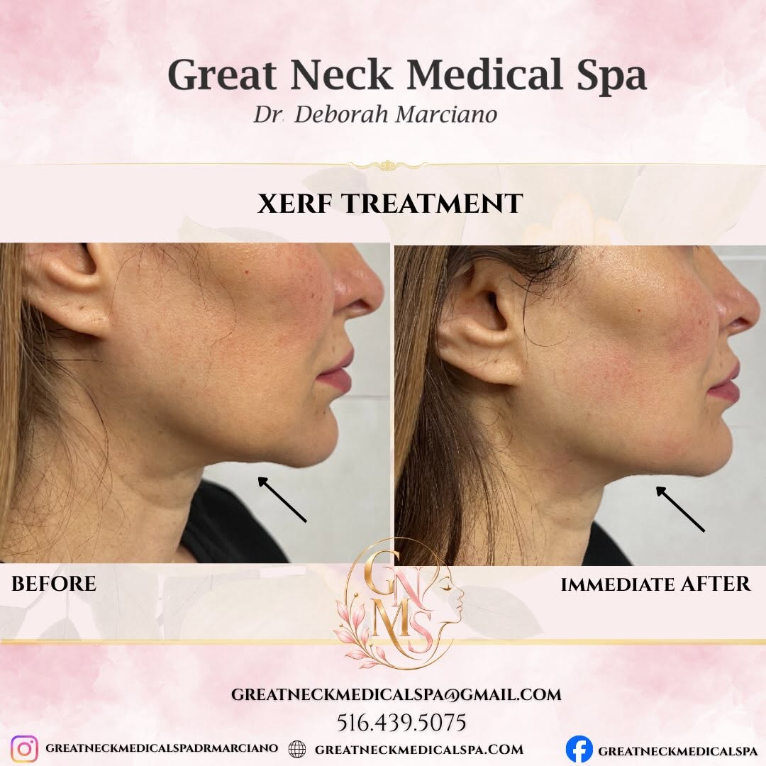 Instagram post by Dr. Deborah Marciano, DO: XERF SKIN TIGHTENING - Lift, tighten and rejuvenate your skin without surgery. XERF uses advanced radio frequency technology to stimulate co…