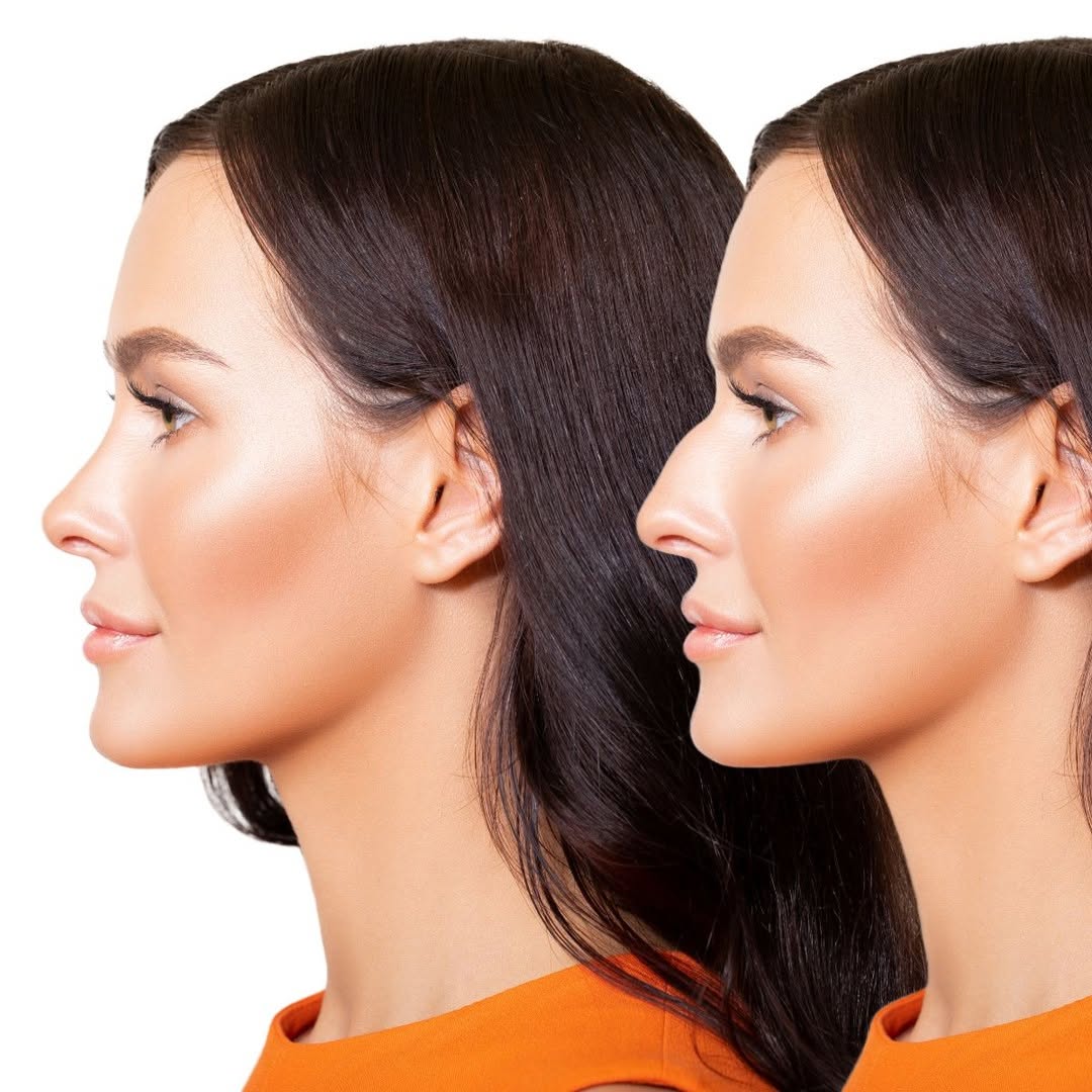 Instagram post by Dr. Deborah Sillins: Bumps and humps on the nasal bridge can also be a result of injury or genetics. Patients often request to flatten out these features during …