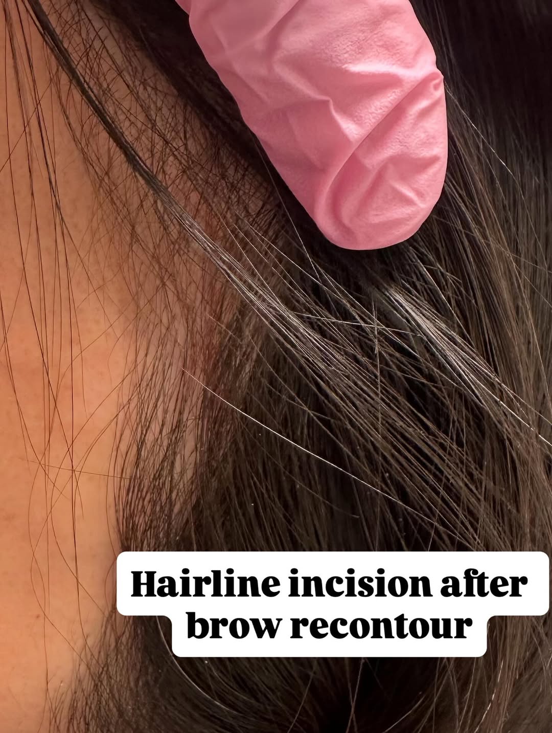 Instagram post by Dr. Debra M. Kroll: This is a photo of a six week postop healing hairline incision of a woman who underwent a brow reset procedure, also called a brow recontour…