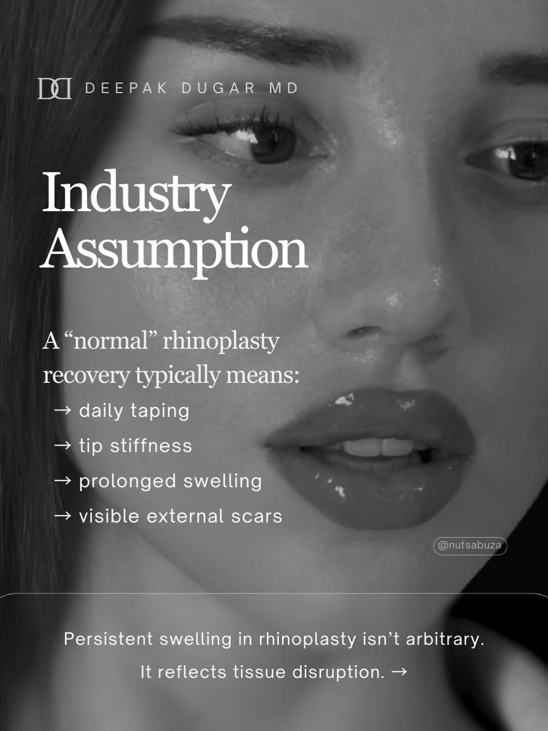 Instagram post by Dr. Deepak Raj Dugar: We present a multi-slide case study of the beautiful @nutsabuza who graciously in a rare moment of transparency shared her Scarless Nose®️ R…