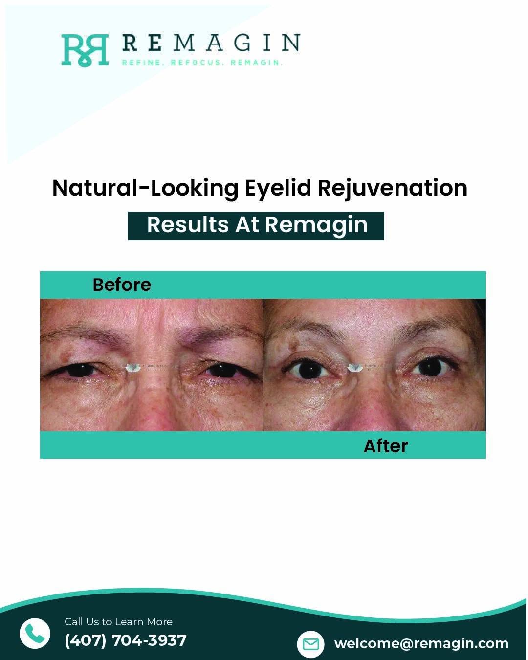 Instagram post by Dr. Deepak Raja: The eyes are often one of the first areas to show signs of aging. Concerns such as excess eyelid skin, puffiness, or heaviness can affect bo…