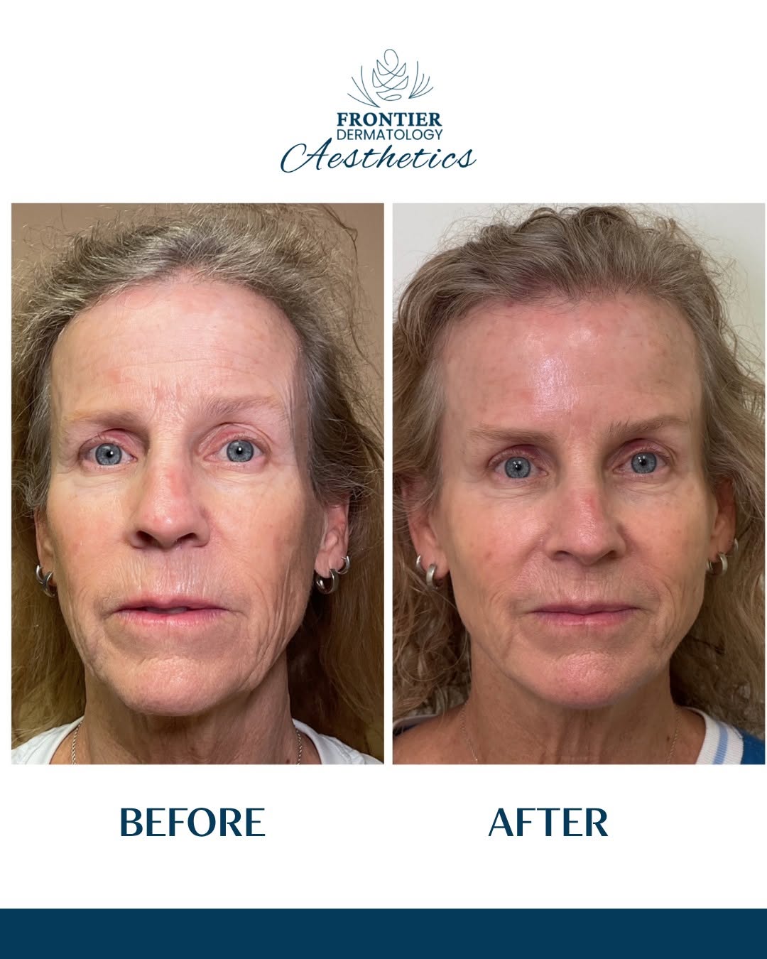 Instagram post by Dr. DeEtta M. Gray: Full-Face Rejuvenation with Liza Hermann, PA-C A refreshed, balanced look—without changing what makes you you For this full-face rejuvenatio…