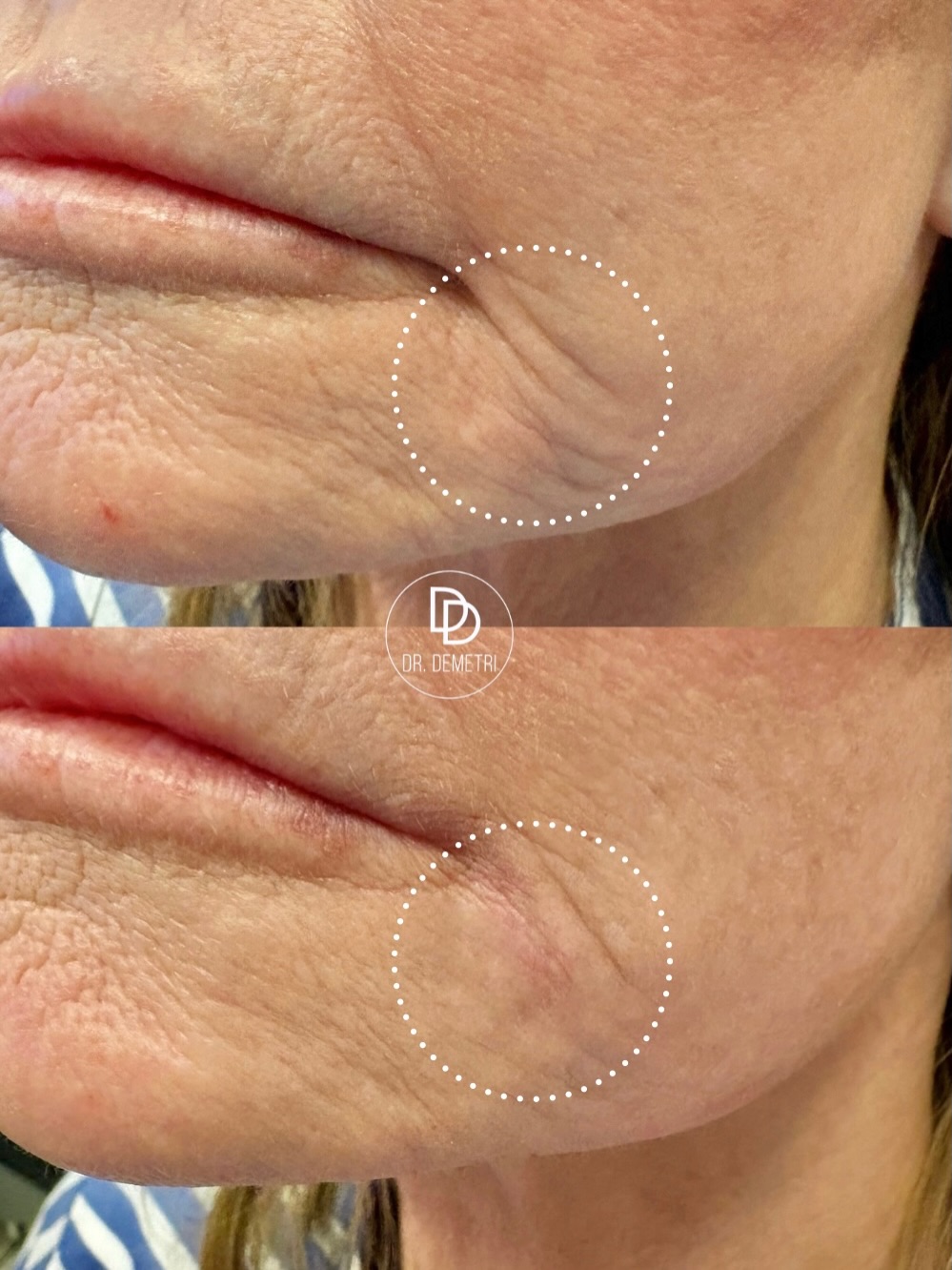 Instagram post by Dr. Demetri Karanzalis, DO: Those lines around the mouth can make you look tired, even when you feel your best. With strategic filler placement, we were able to soften …