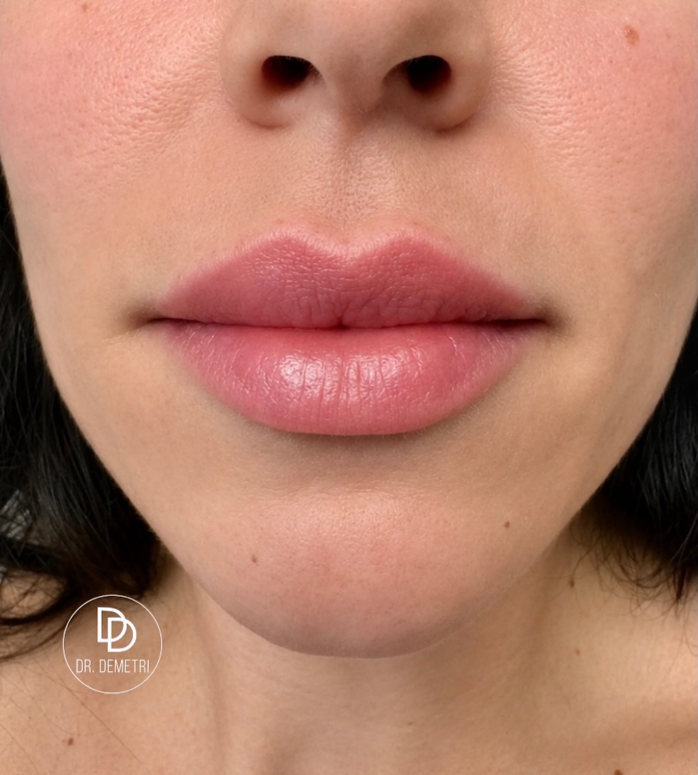 Instagram post by Dr. Demetri Karanzalis, DO: The best lip filler is the kind no one can identify. Beautiful lips shouldn’t announce that filler was used. They should simply look hydrate…