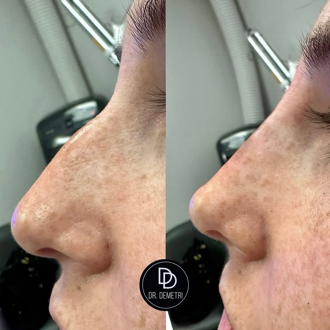 Instagram post by Dr. Demetri Karanzalis, DO: A non-surgical rhinoplasty is not a one-size-fits-all treatment because no two noses are the same. Every nose has its own unique anatomy, pr…