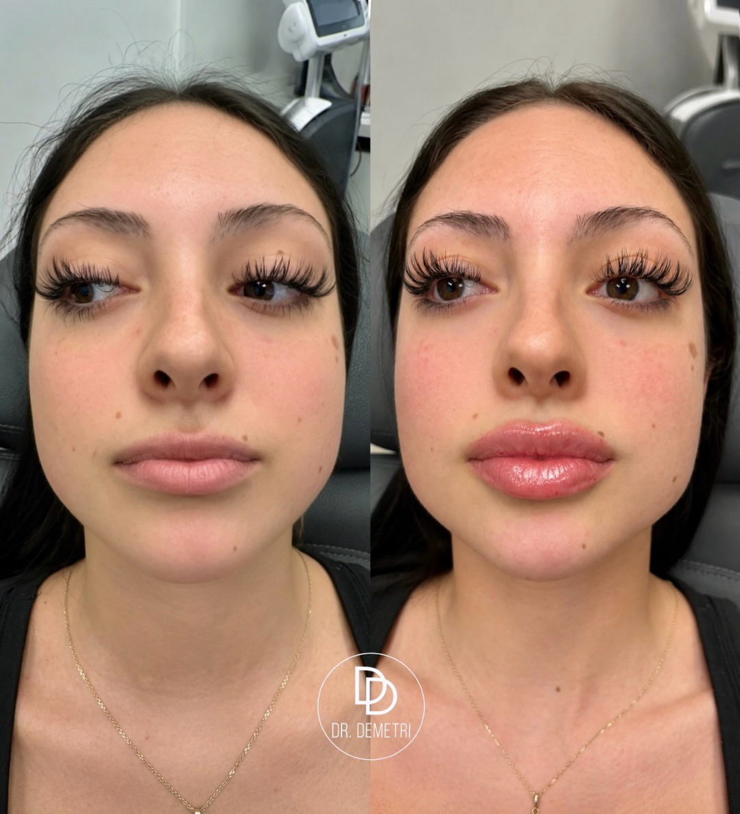 Instagram post by Dr. Demetri Karanzalis, DO: Beautiful lips begin with balance. A customized approach to lip filler, designed to enhance natural shape, restore subtle volume, and create…