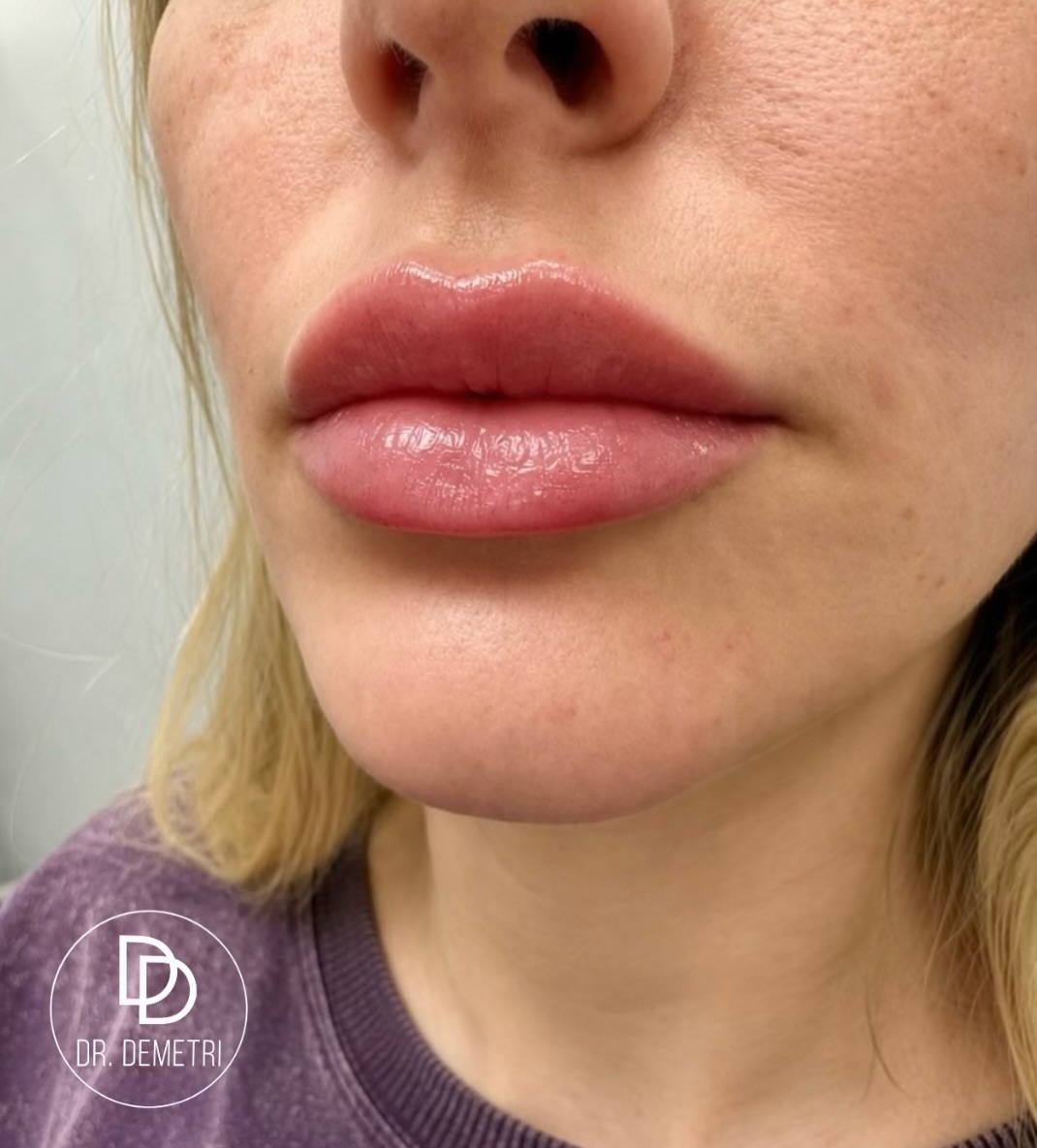 Instagram post by Dr. Demetri Karanzalis, DO: Every lip treatment begins with an understanding of facial anatomy, proportion, and the patient’s goals. Lip filler is not simply about addi…