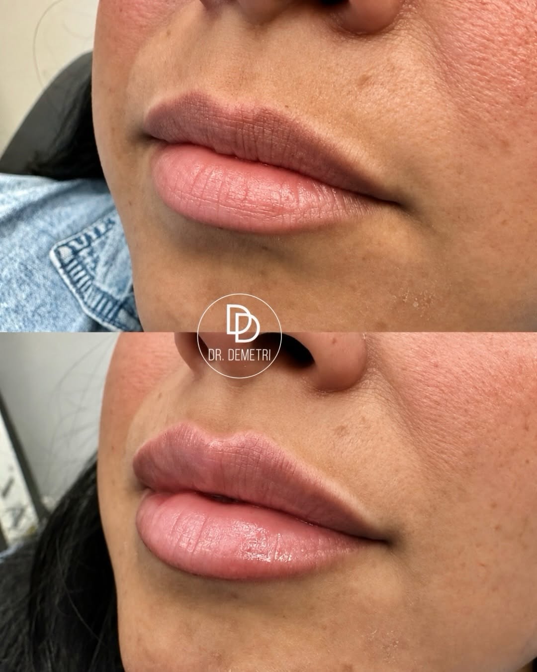Instagram post by Dr. Demetri Karanzalis, DO: THE ART OF A BEAUTIFUL LIP ENHANCEMENT. Lip filler isn’t simply about adding volume. It’s about enhancing what’s already there with intentio…