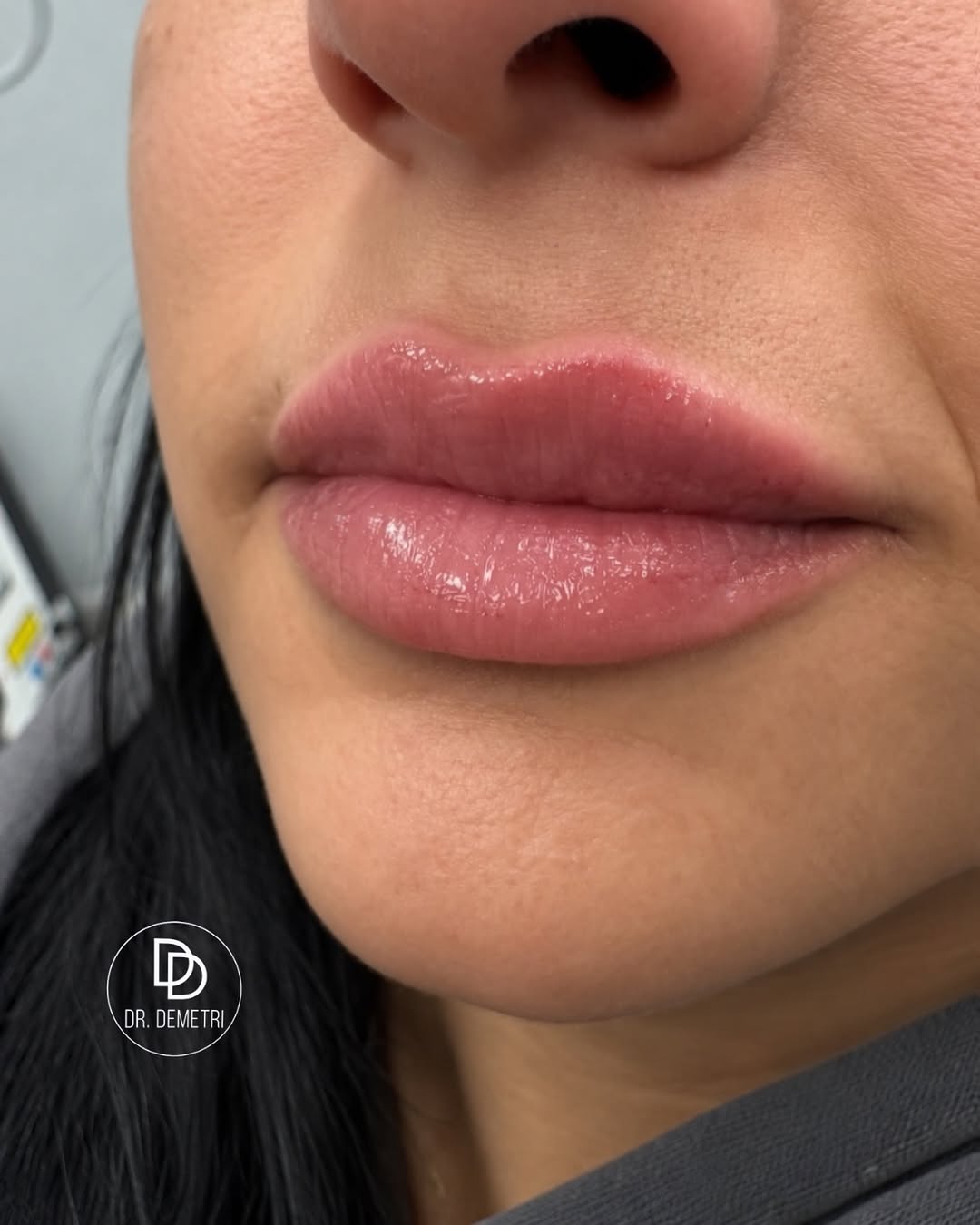 Instagram post by Dr. Demetri Karanzalis, DO: Precision in every detail. Lip filler isn’t just about adding volume. It’s about enhancing shape, definition, balance, and proportion while …