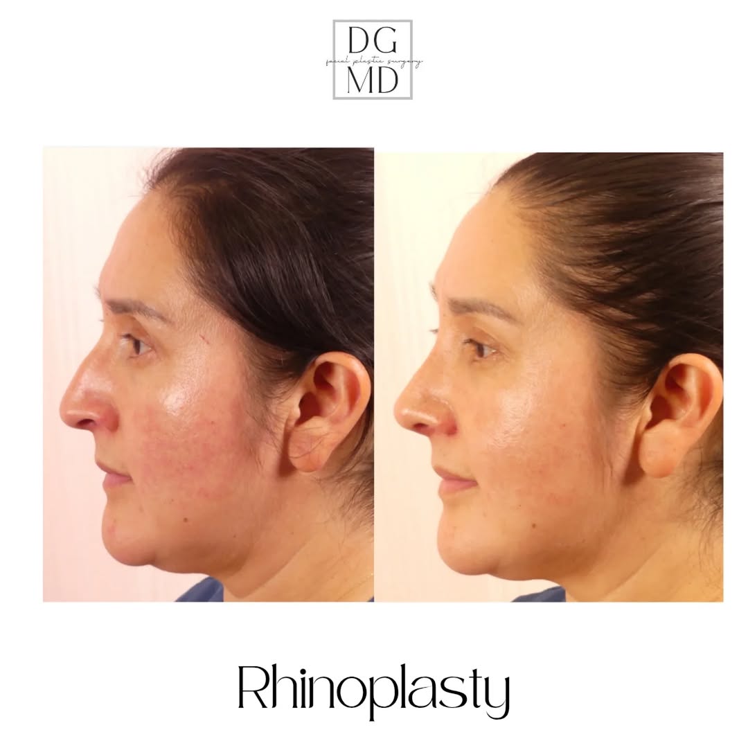 Instagram post by Dr. Deniz Gerecci: 1 month post op rhinoplasty results of this sweet, beautiful patient! In my last post she was pictured 1 week out. Here she is 3 weeks later…