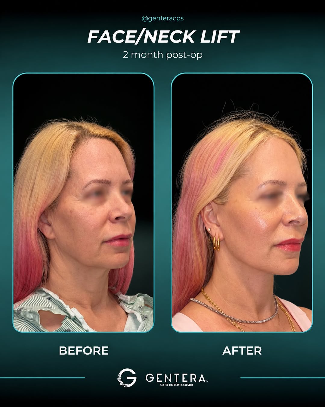 Instagram post by Dr. Deniz Gocken: Two months post-op, and the results already speak for themselves 😍 A Face/Neck Lift isn’t about looking different. It’s about looking like …